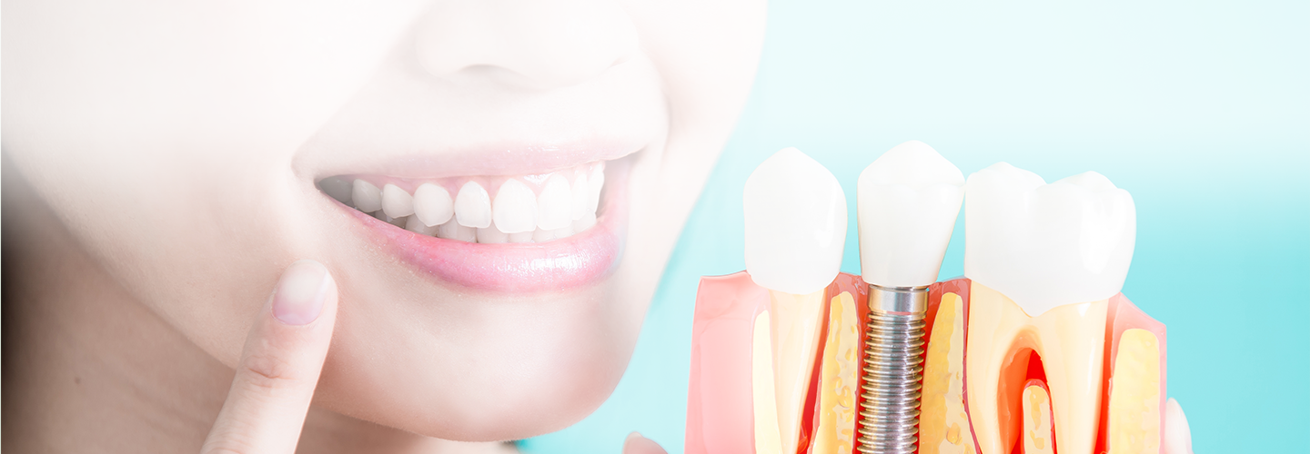 Dental Implants